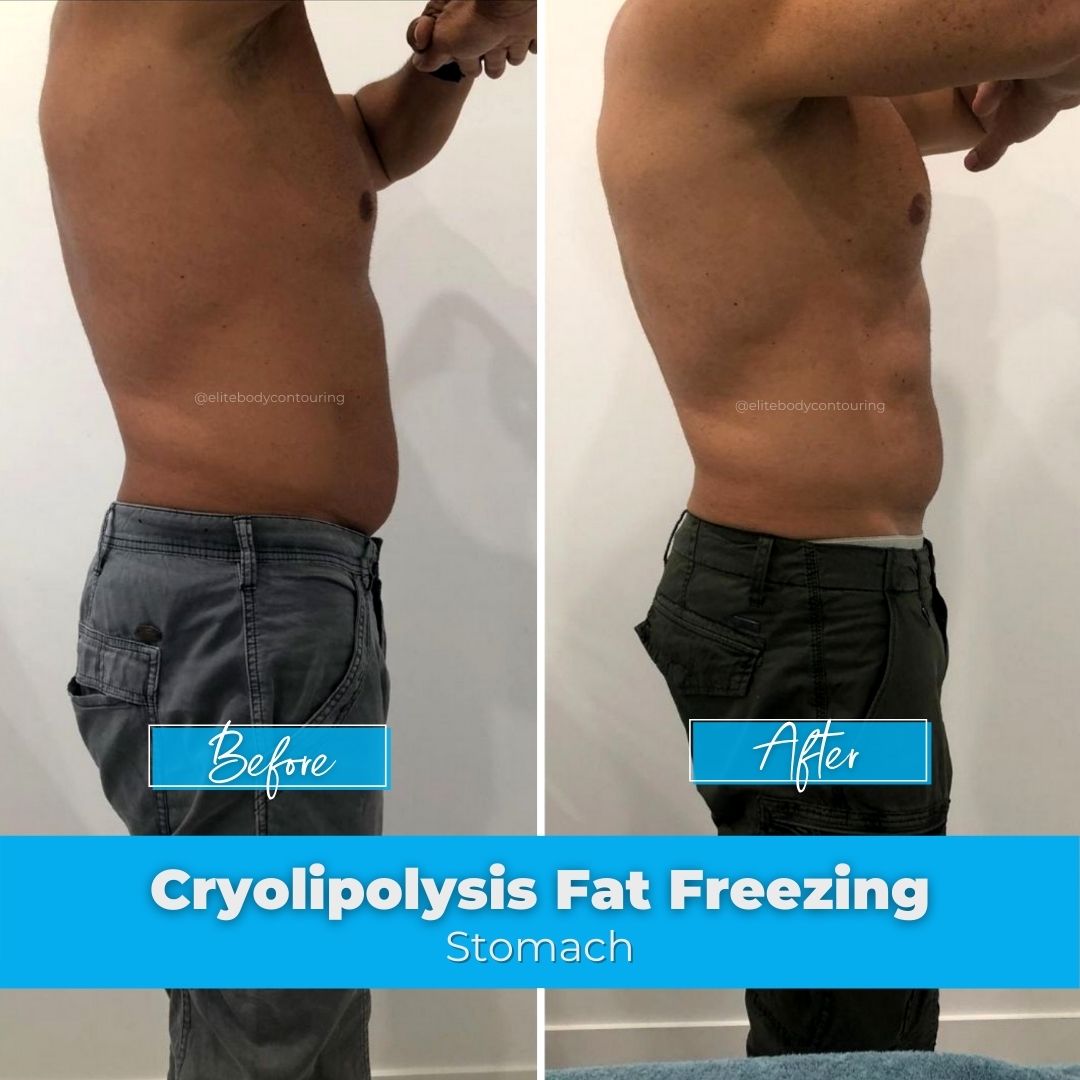 Fat Freezing Sydney | Cryolipolysis | Elite Body Contouring