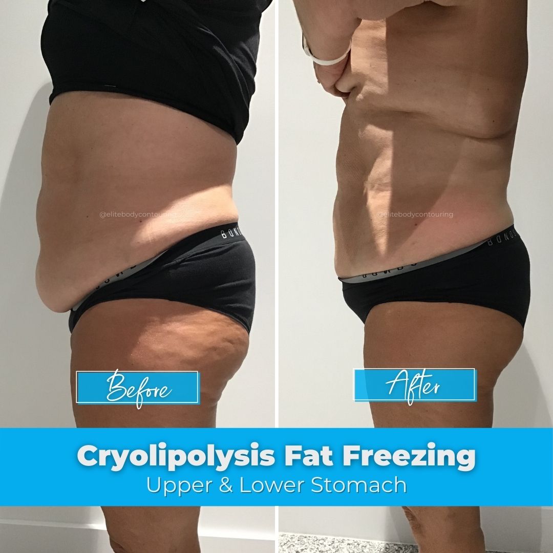 02. Fat Freezing - Upper & Lower Stomach
