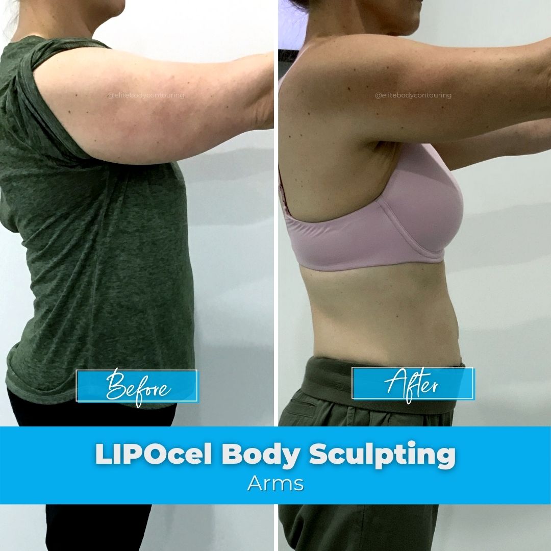 02. LIPOcel Body Sculpting - Arms