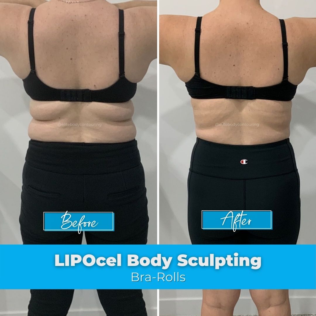 LIPOcel Body Sculpting Results Elite Body Contouring