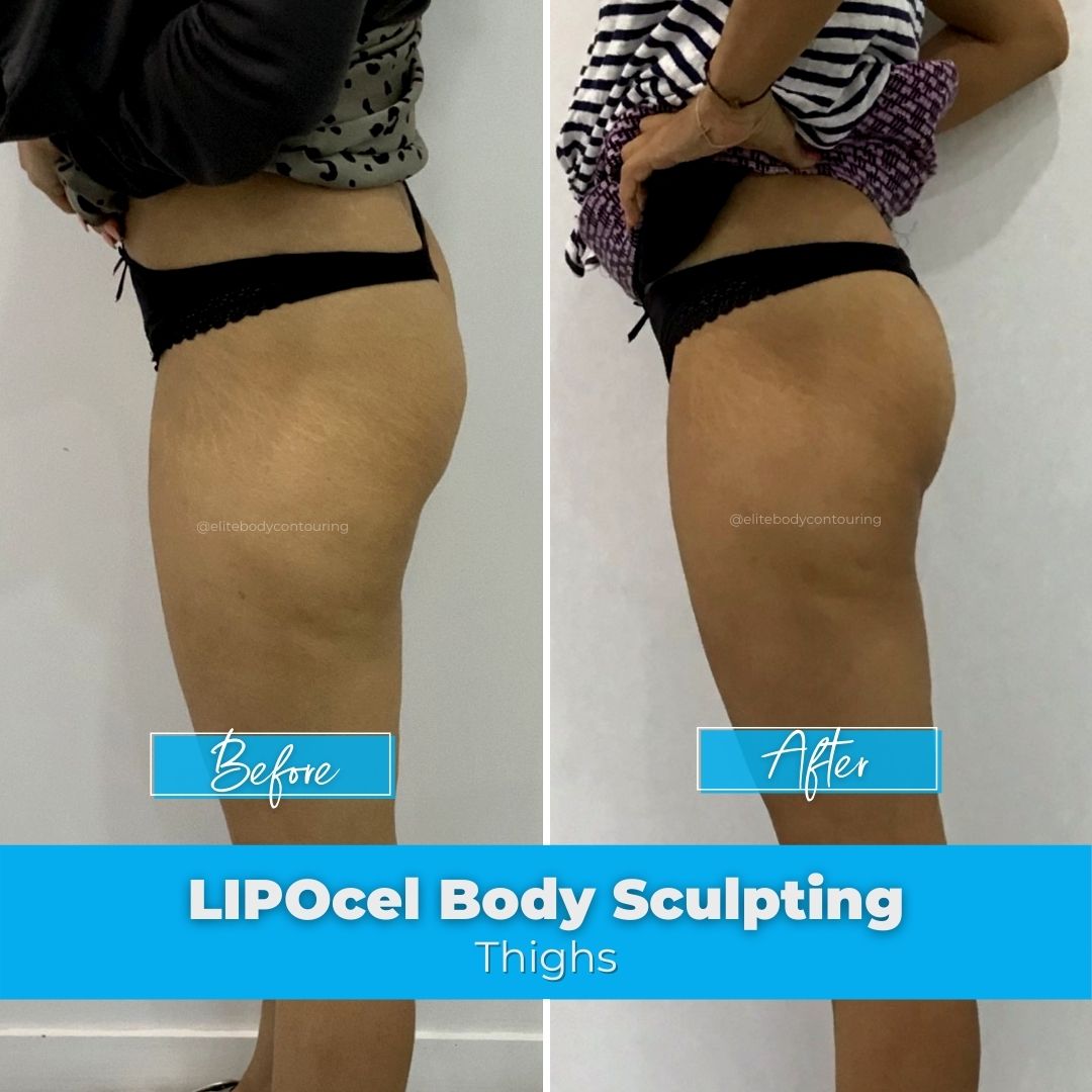 02. LIPOcel Body Sculpting - Thighs