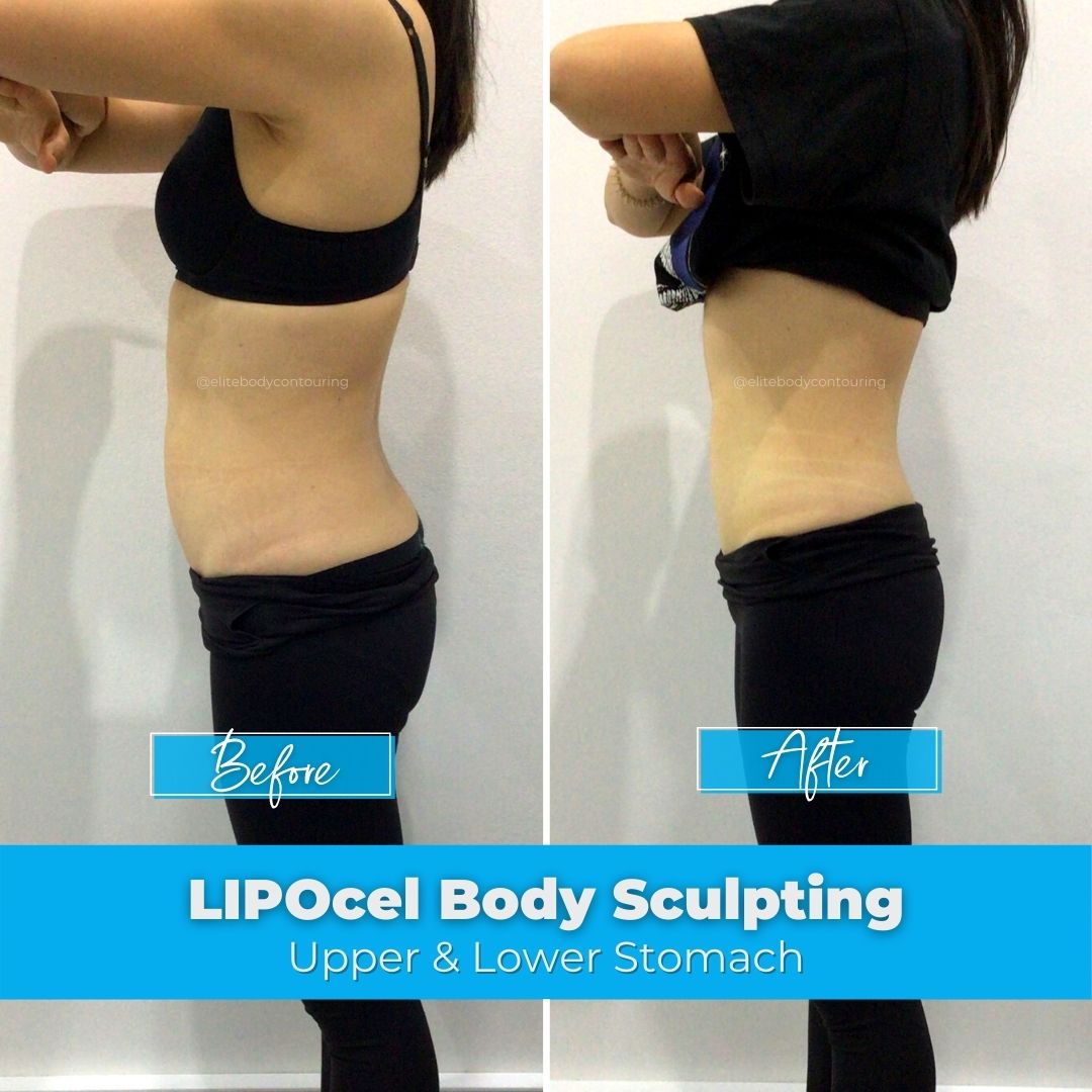 02. LIPOcel Body Sculpting - Upper & Lower Stomach