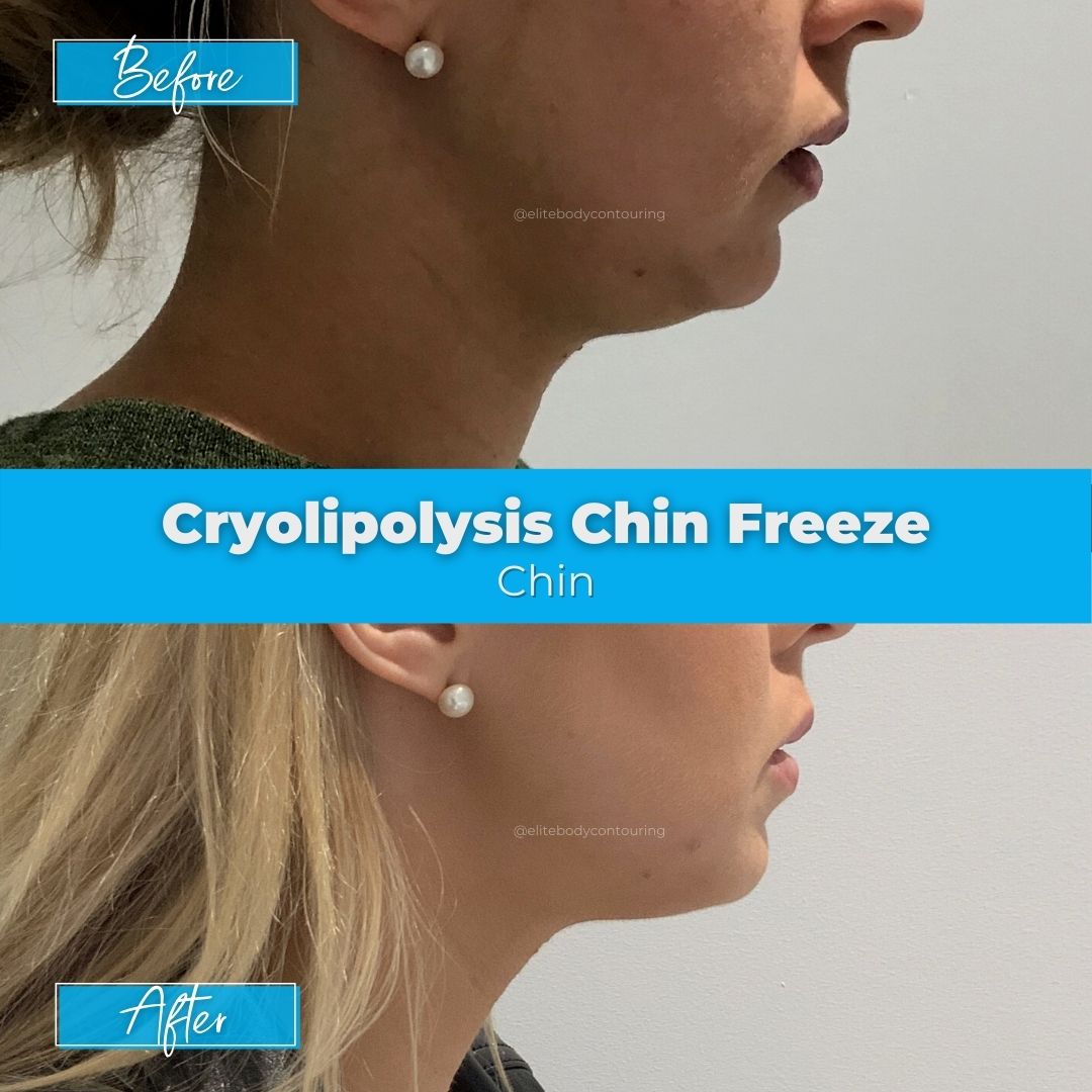 03. Cryolipolysis Chin Freeze