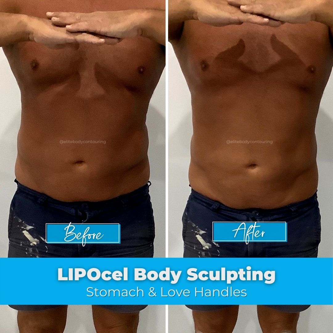 LIPOcel Body Sculpting HIFU Elite Body Contouring