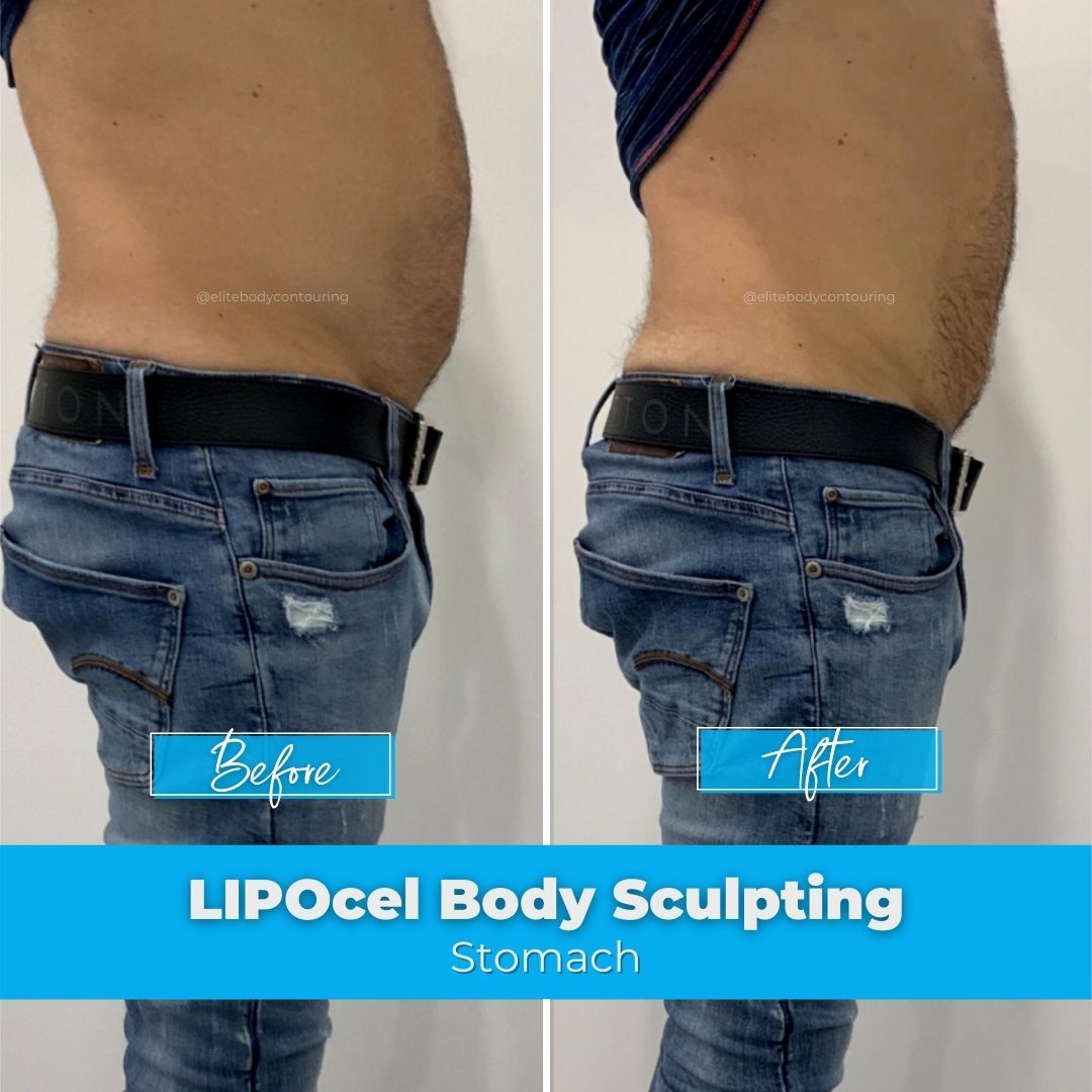 LIPOcel Body Sculpting HIFU Elite Body Contouring