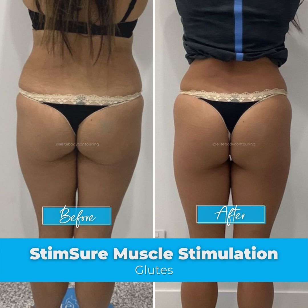 03. StimSure Muscle Stimulation - Glutes