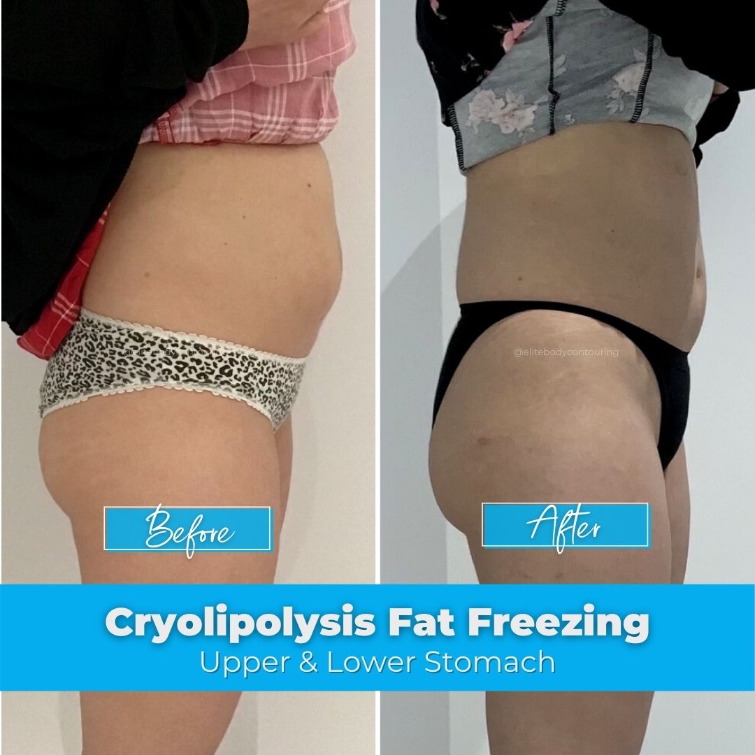 04. Fat Freezing - Upper & Lower Stomach