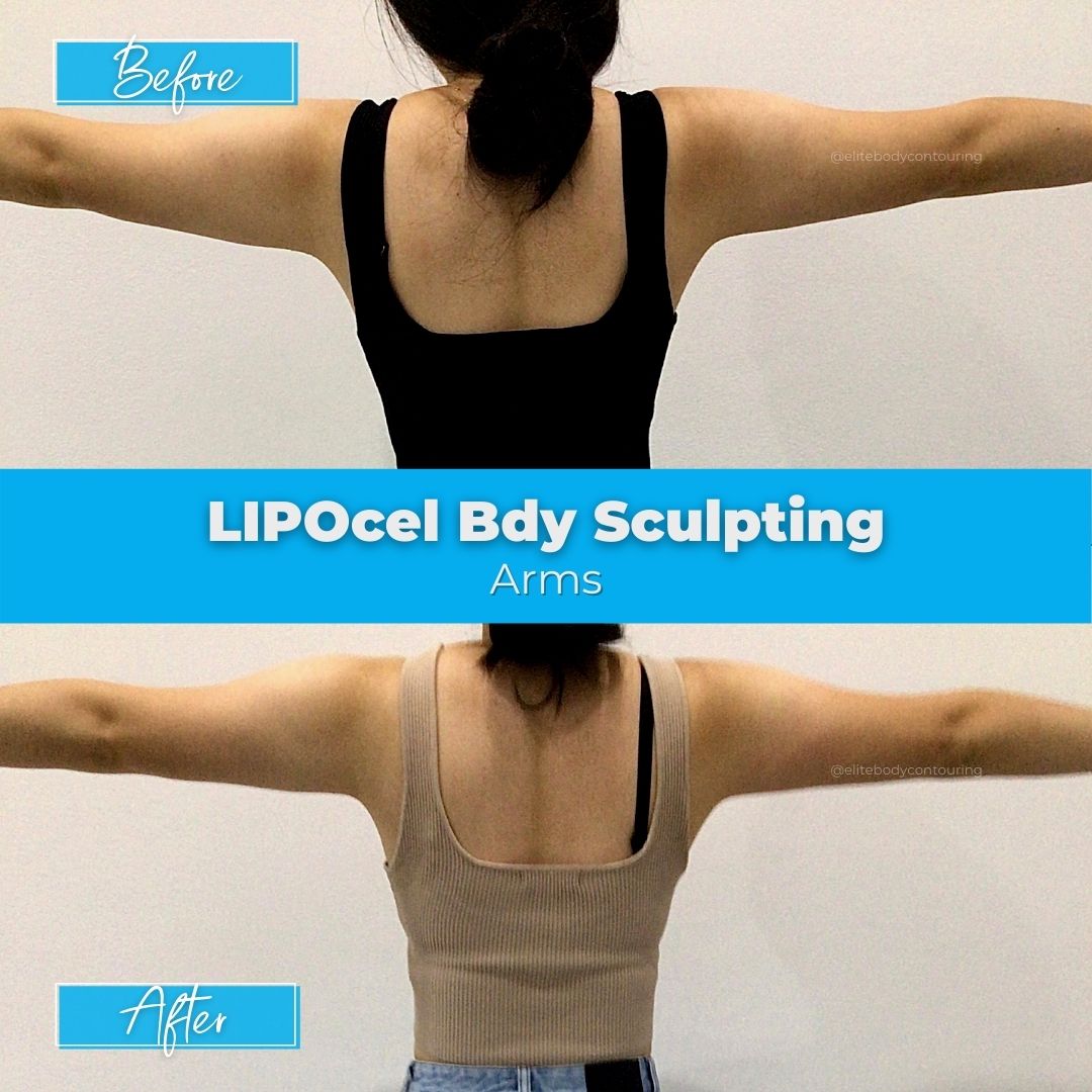 LIPOcel Body Sculpting HIFU Elite Body Contouring