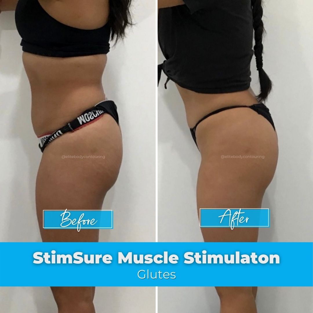 04. StimSure Muscle Stimulation - Glutes