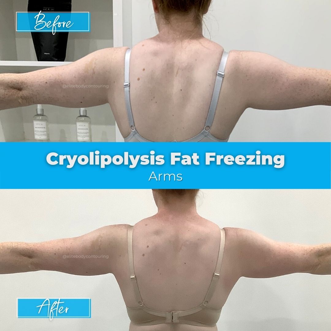 Fat Freezing Sydney | Cryolipolysis | Elite Body Contouring