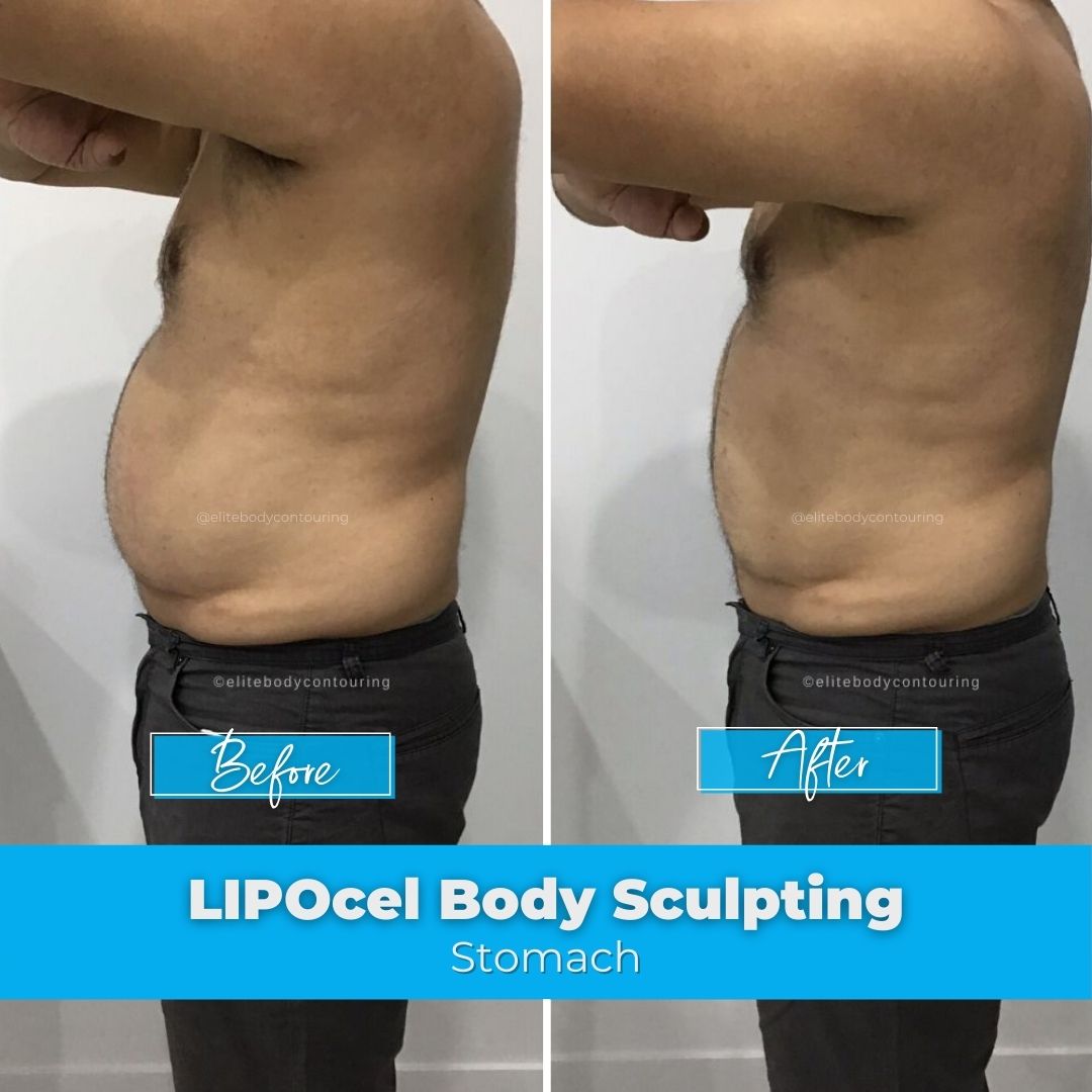 LIPOcel Body Sculpting HIFU Elite Body Contouring