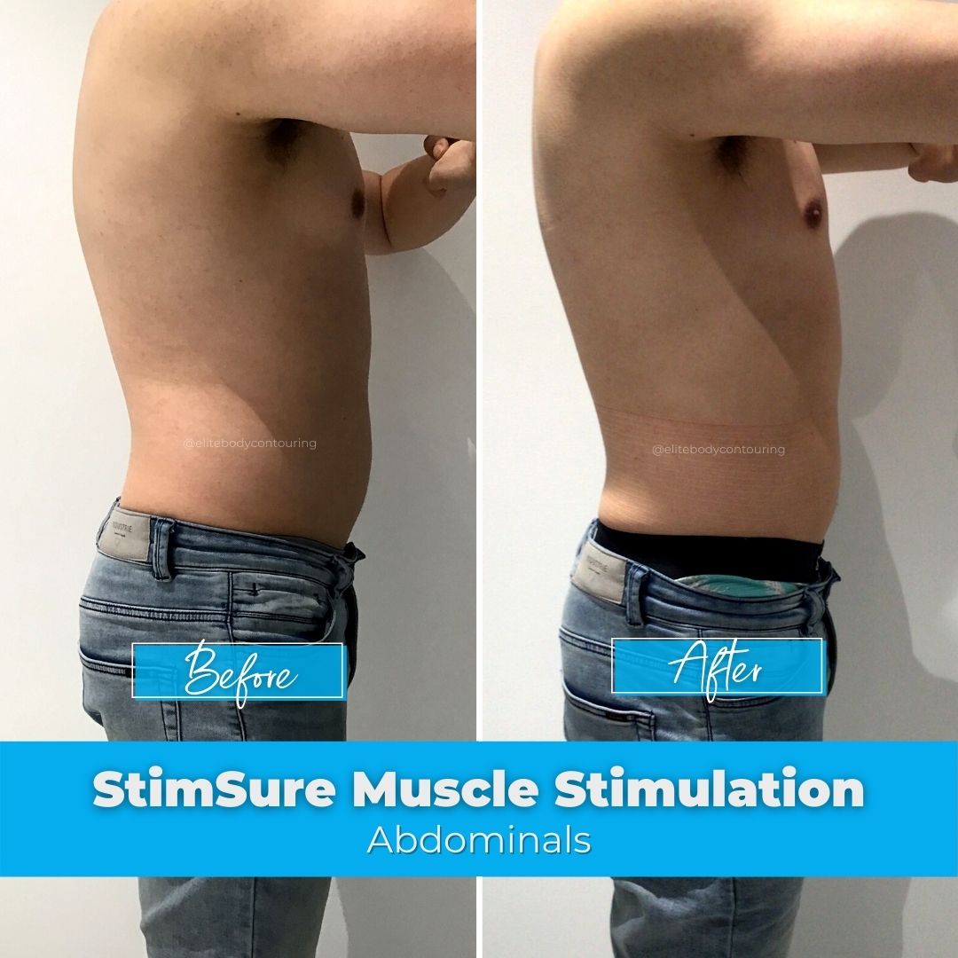 05. StimSure Muscle Stimulation - Abdominals