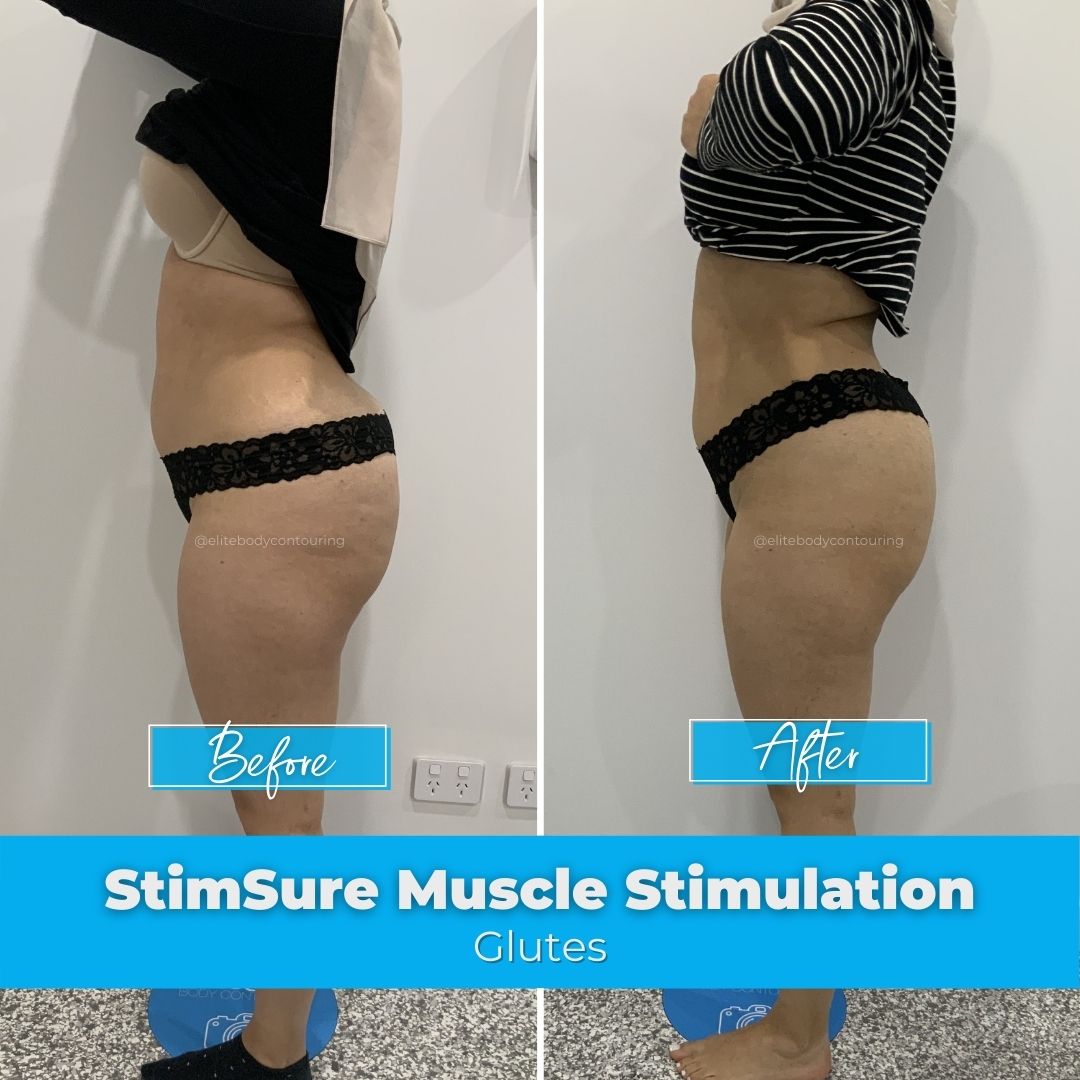 05. StimSure Muscle Stimulation - Glutes