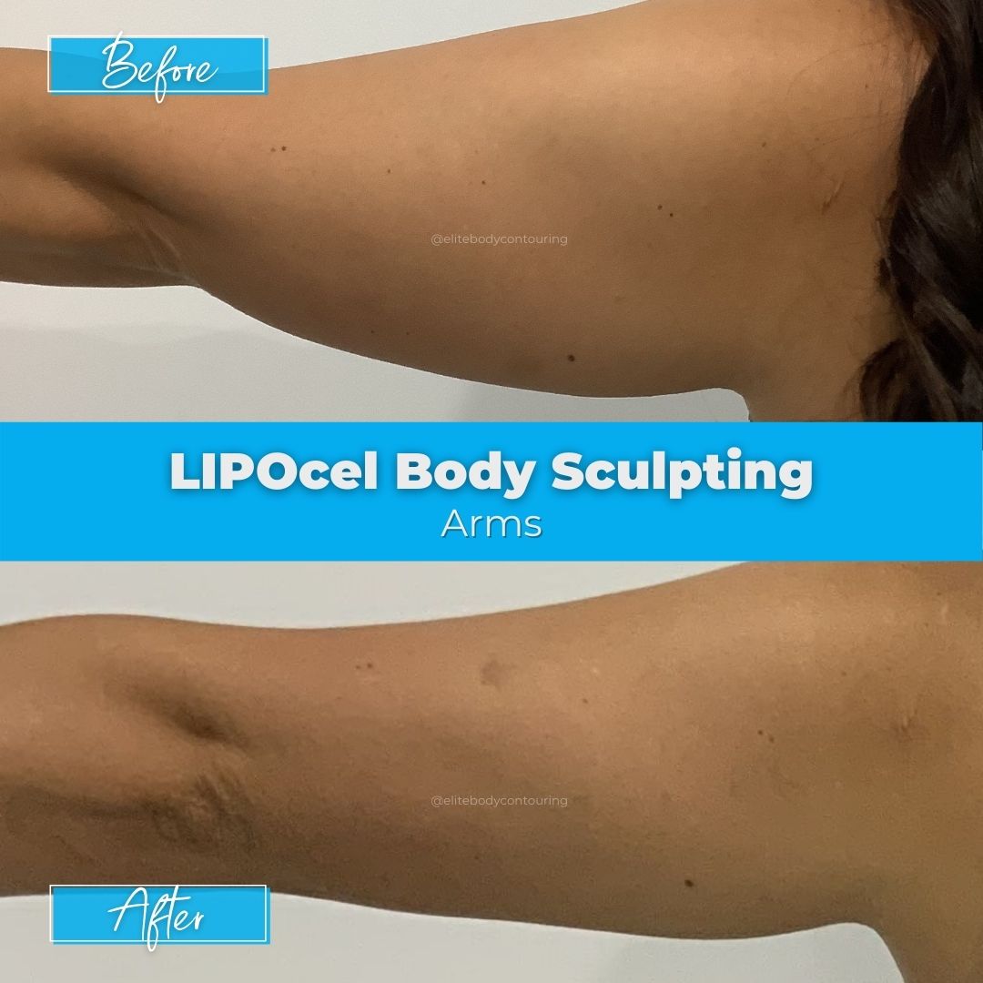06. LIPOcel Body Sculpting - Arms