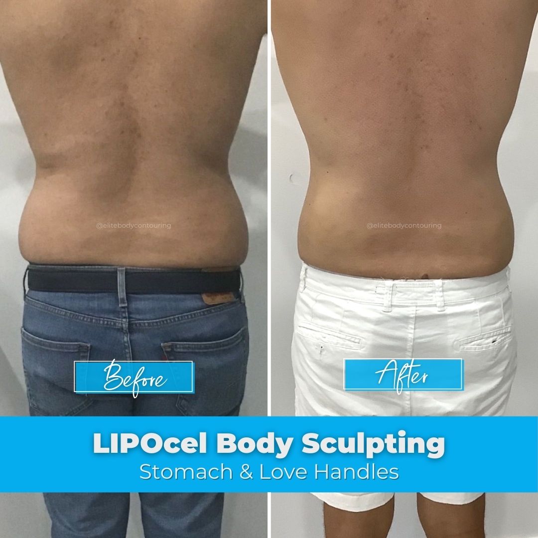 06. LIPOcel Body Sculpting - Stomach & Love Handles