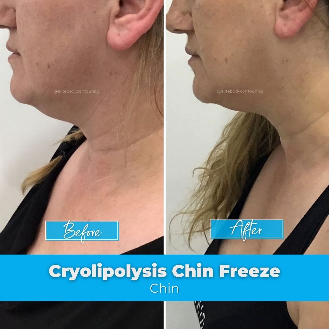 07. Cryolipolysis Chin Freeze