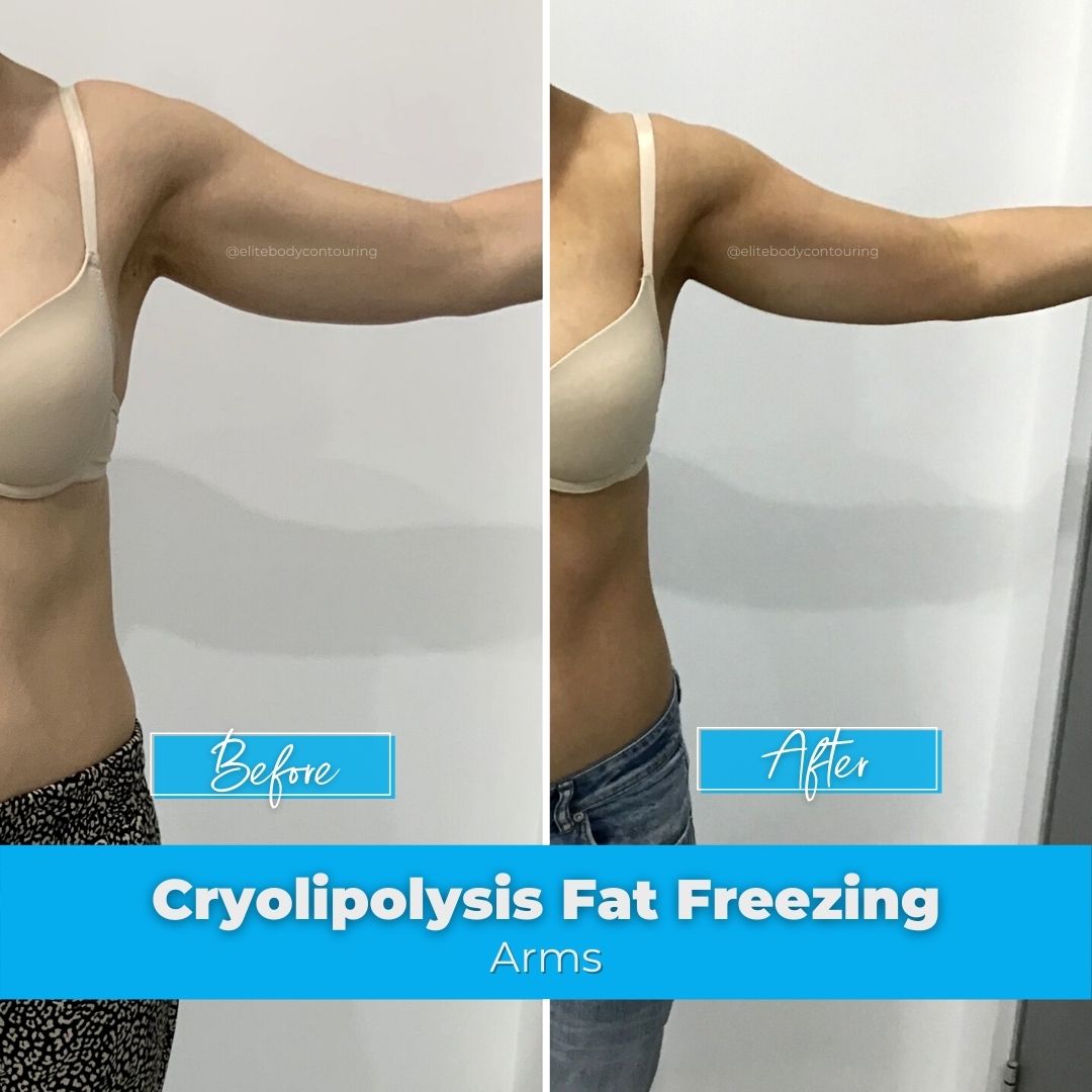 Fat Freezing Results | Elite Body Contouring