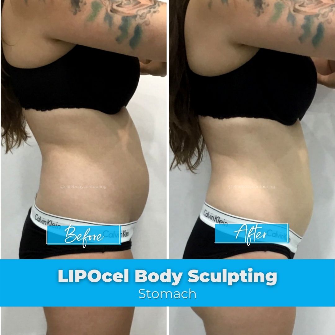 07. LIPOcel Body Sculpting - Stomach