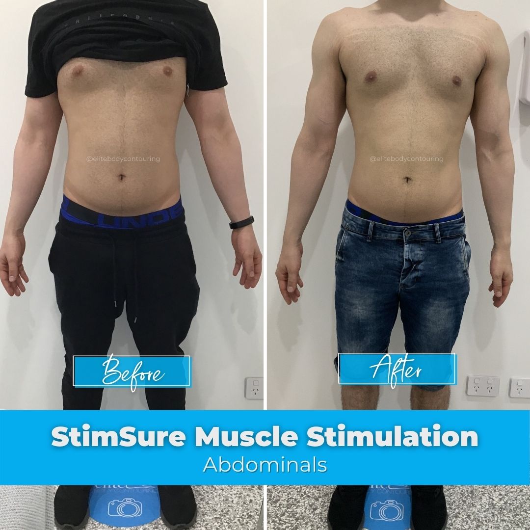 07. StimSure Muscle Stimulation - Abdominals