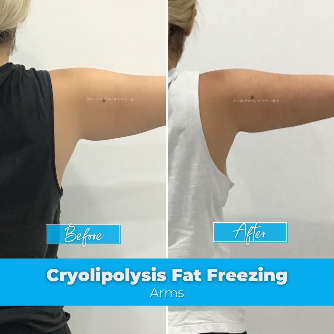 Fat Freezing Sydney Cryolipolysis Elite Body Contouring