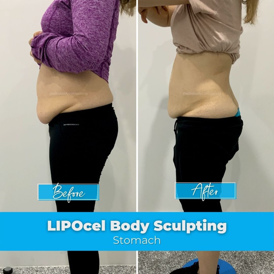 08. LIPOcel Body Sculpting - Stomach