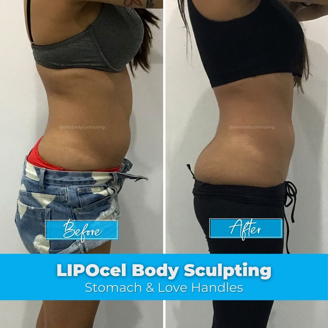 09. LIPOcel Body Sculpting - Stomach & Love Handles