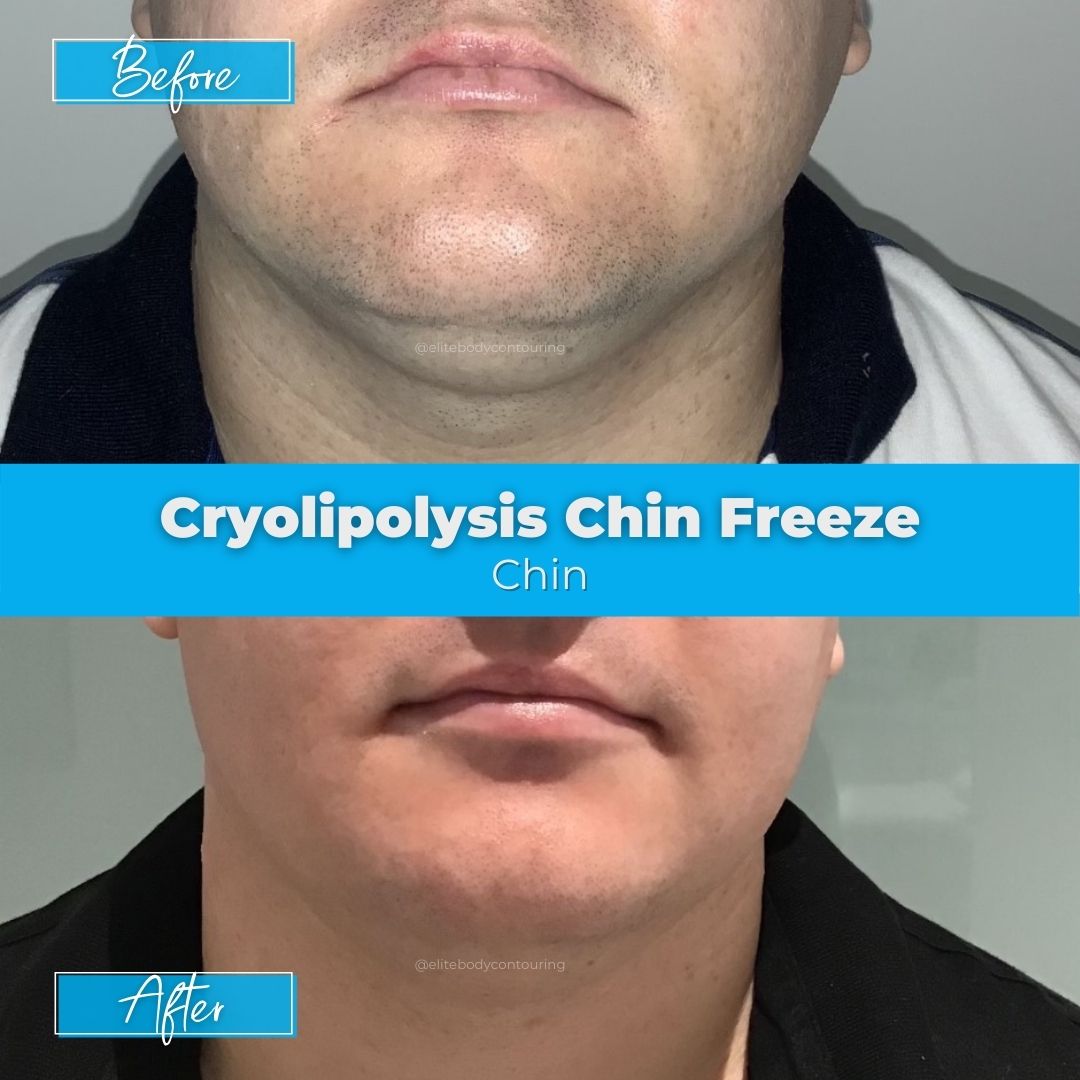 Cryolipolysis Chin Freeze