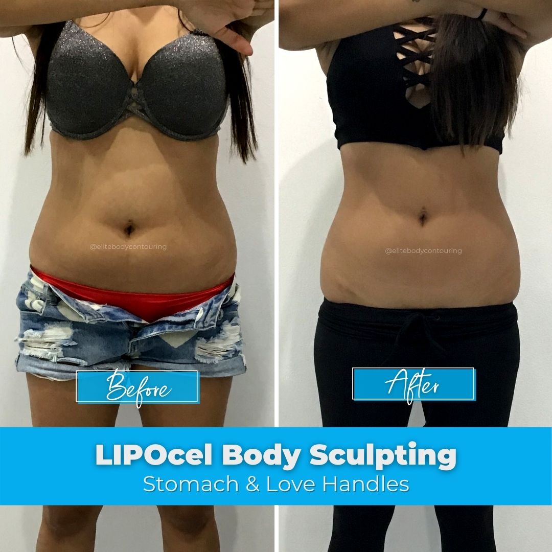 11. LIPOcel Body Sculpting - Stomach & Love Handles
