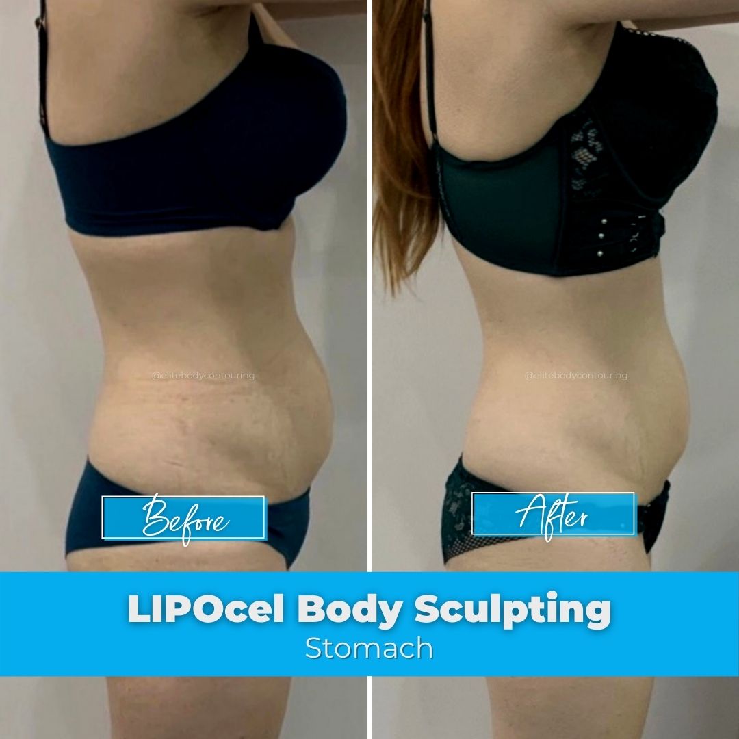 11. LIPOcel Body Sculpting - Stomach