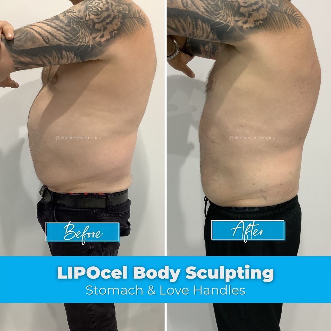 LIPOcel Body Sculpting HIFU Elite Body Contouring