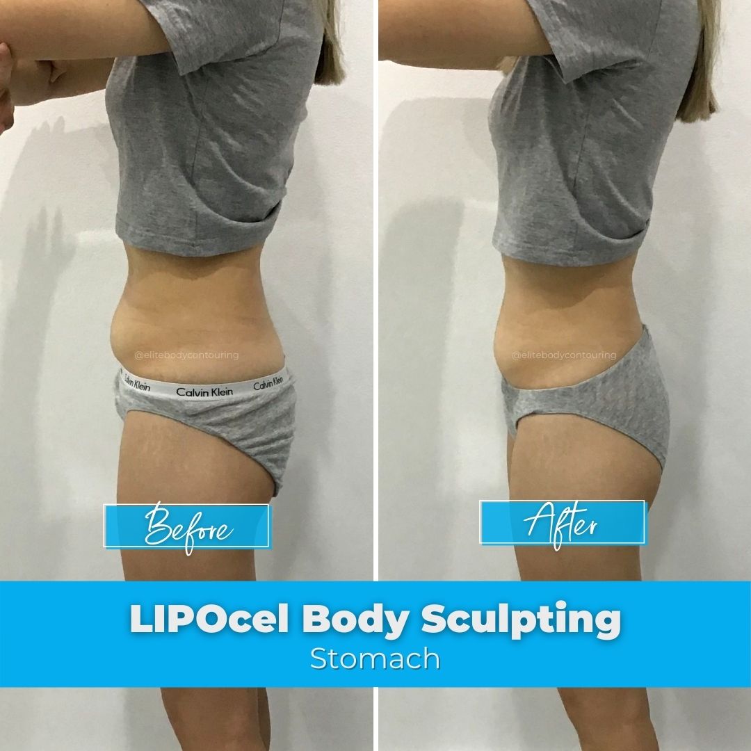 12. LIPOcel Body Sculpting - Stomach