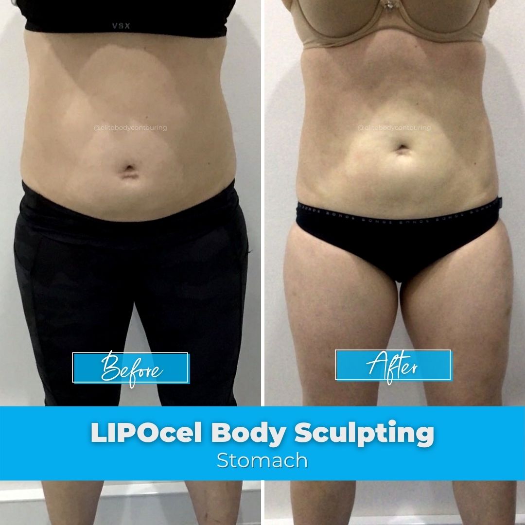 18. LIPOcel Body Sculpting - Stomach