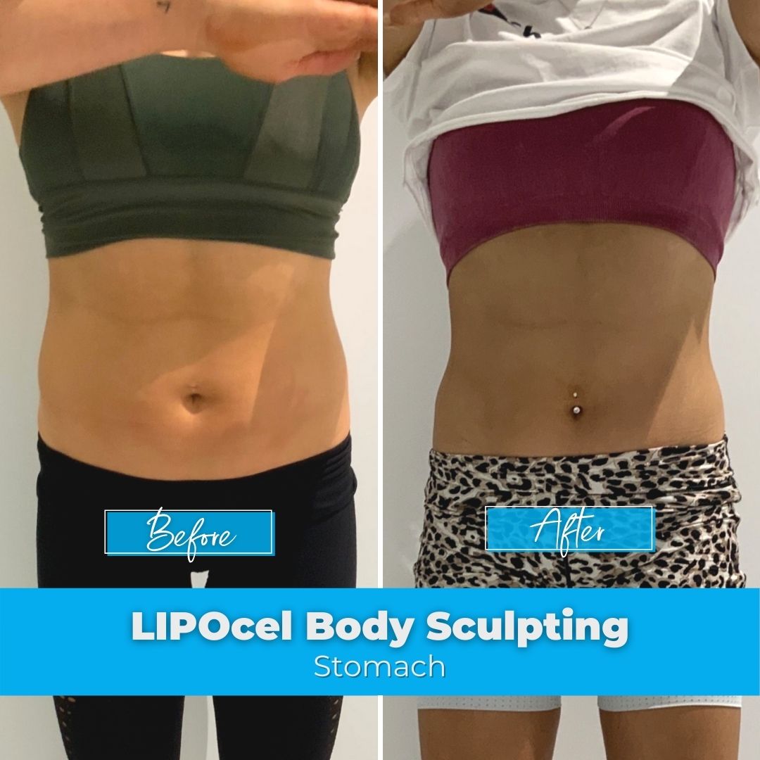 20. LIPOcel Body Sculpting - Stomach