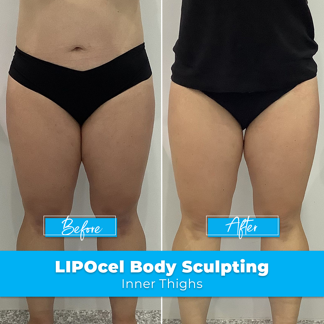 01. LIPOcel Body Sculpting - Inner Thighs