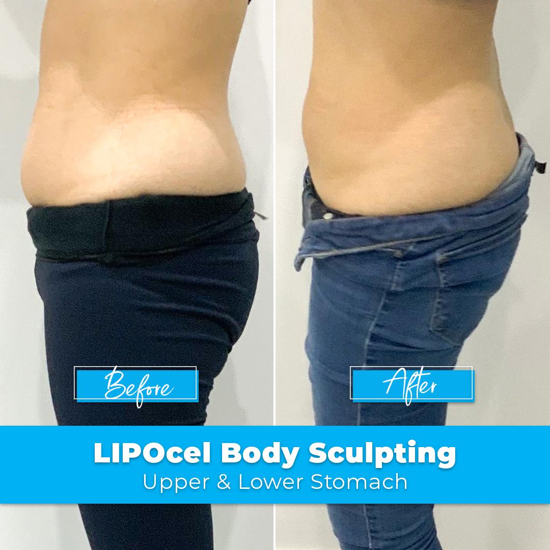 02. LIPOcel Body Sculpting - Upper & Lower Stomach