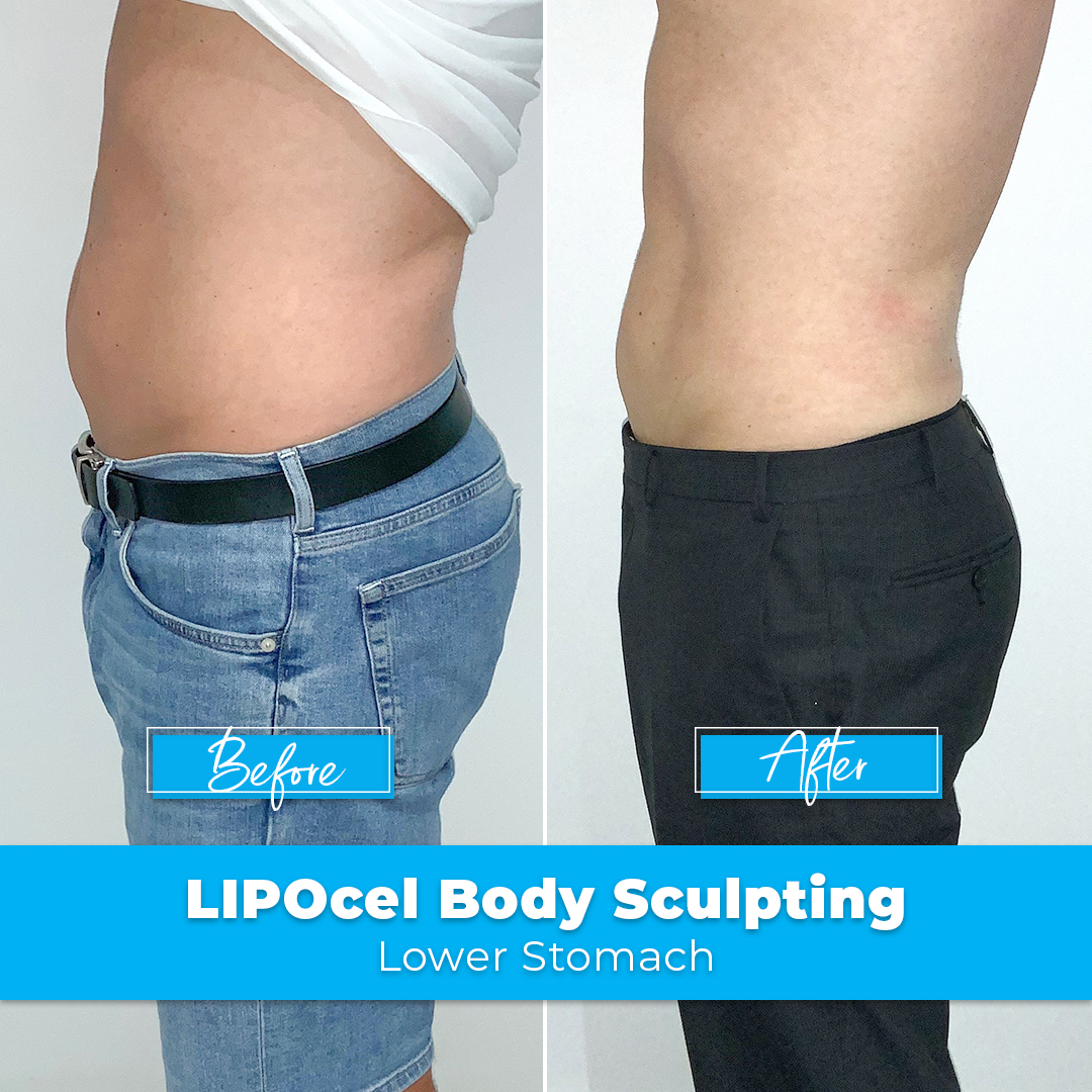 LIPOcel Body Sculpting HIFU Elite Body Contouring