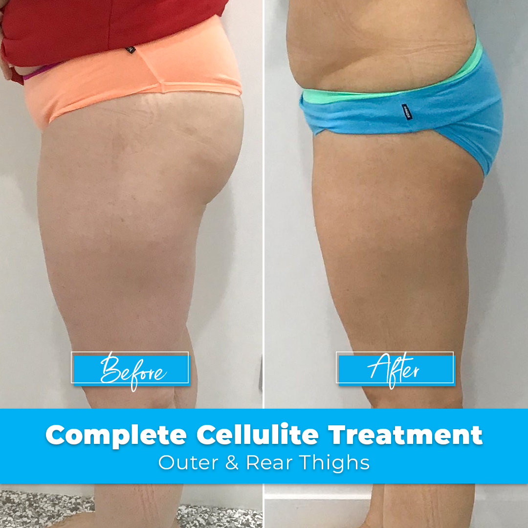 04. Complete Cellulite Treatment - Thighs & Buttocks