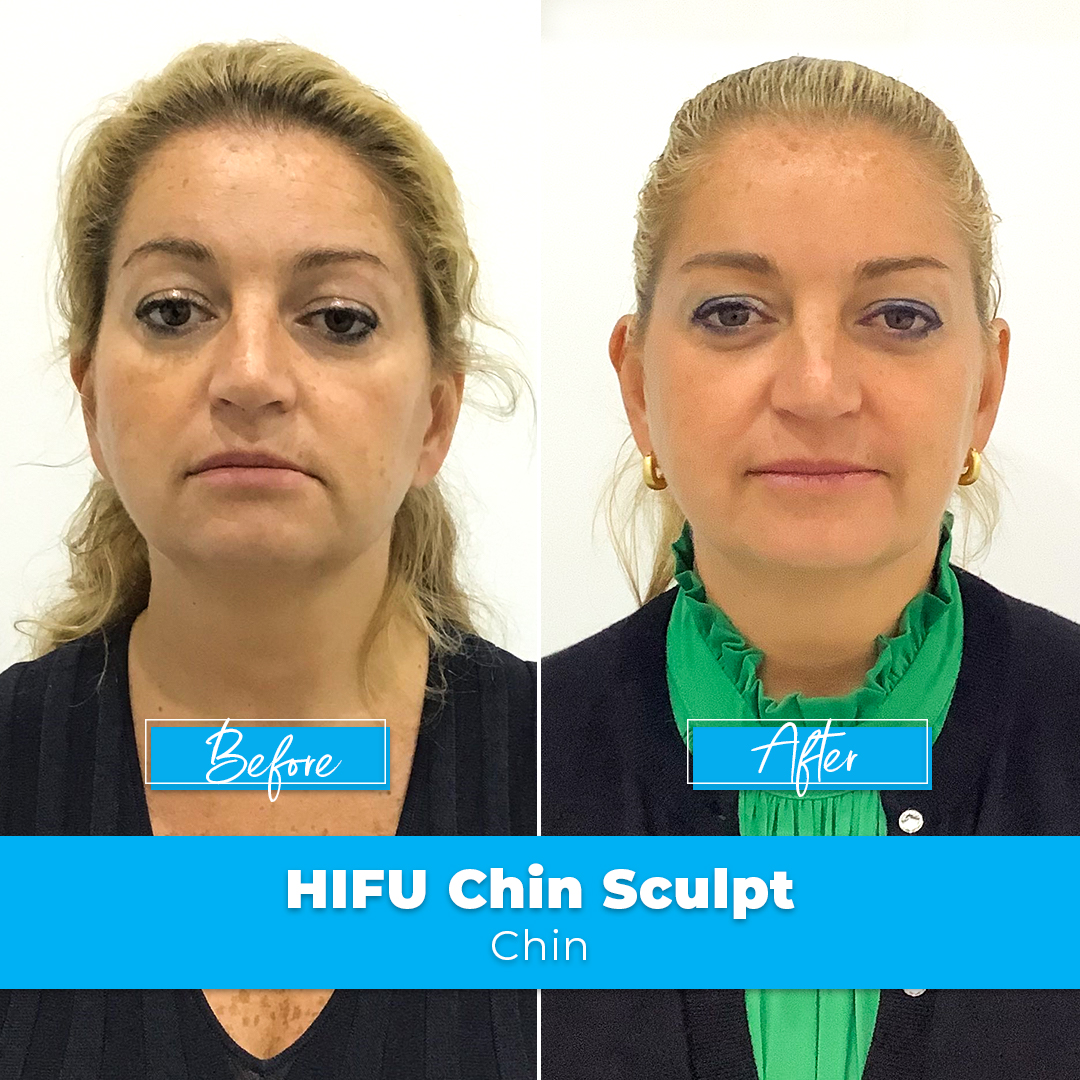 Chin Sculpting | HIFU | Double Chin | Elite Body Contouring