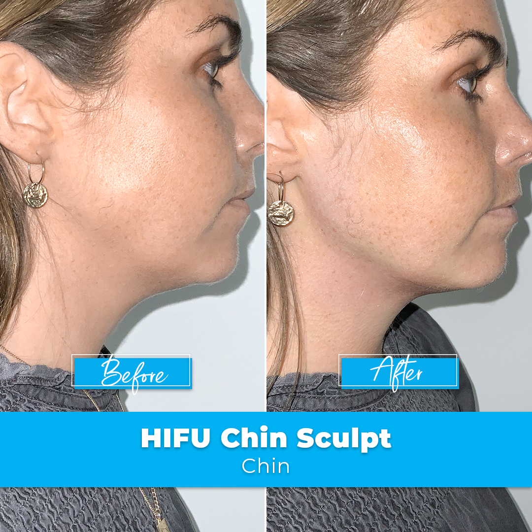 Chin Sculpting | HIFU | Double Chin | Elite Body Contouring