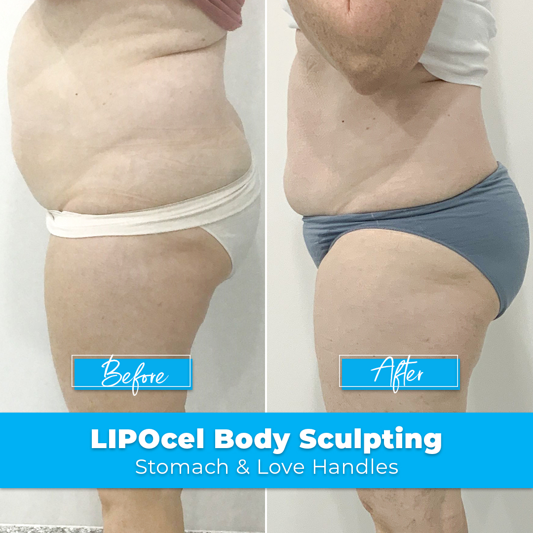 13. LIPOcel Body Sculpting - Stomach & Love Handles
