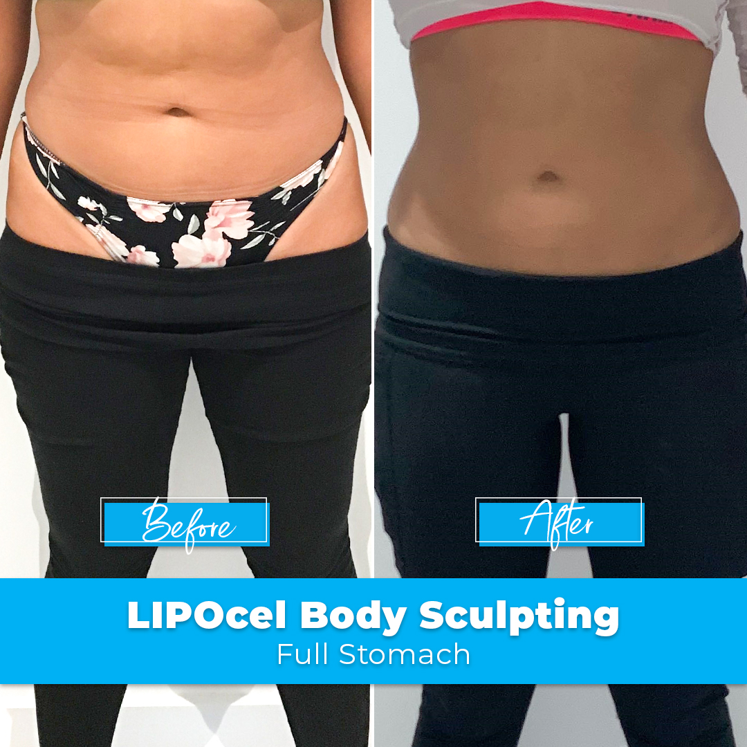 LIPOcel Body Sculpting HIFU Elite Body Contouring