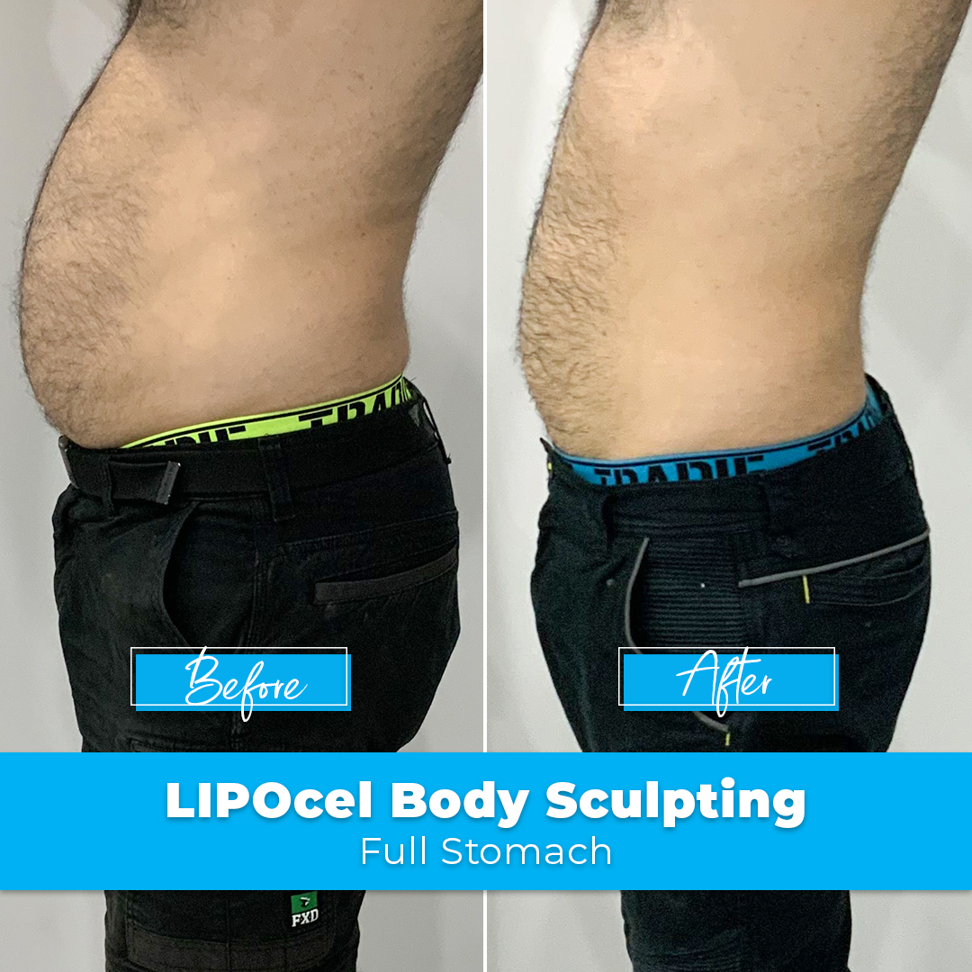 23. LIPOcel Body Sculpting - Stomach