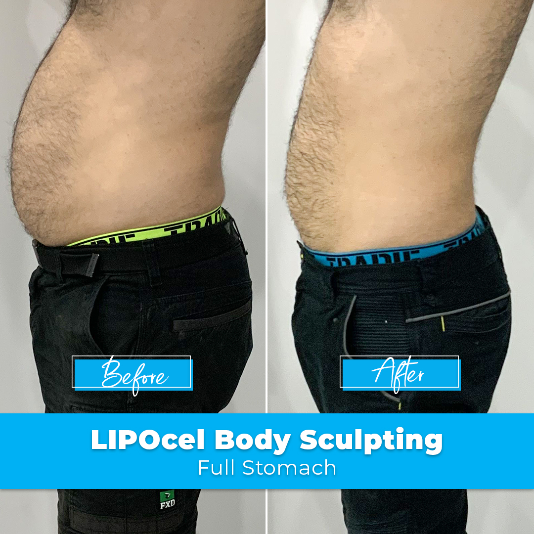 LIPOcel Body Sculpting HIFU Elite Body Contouring