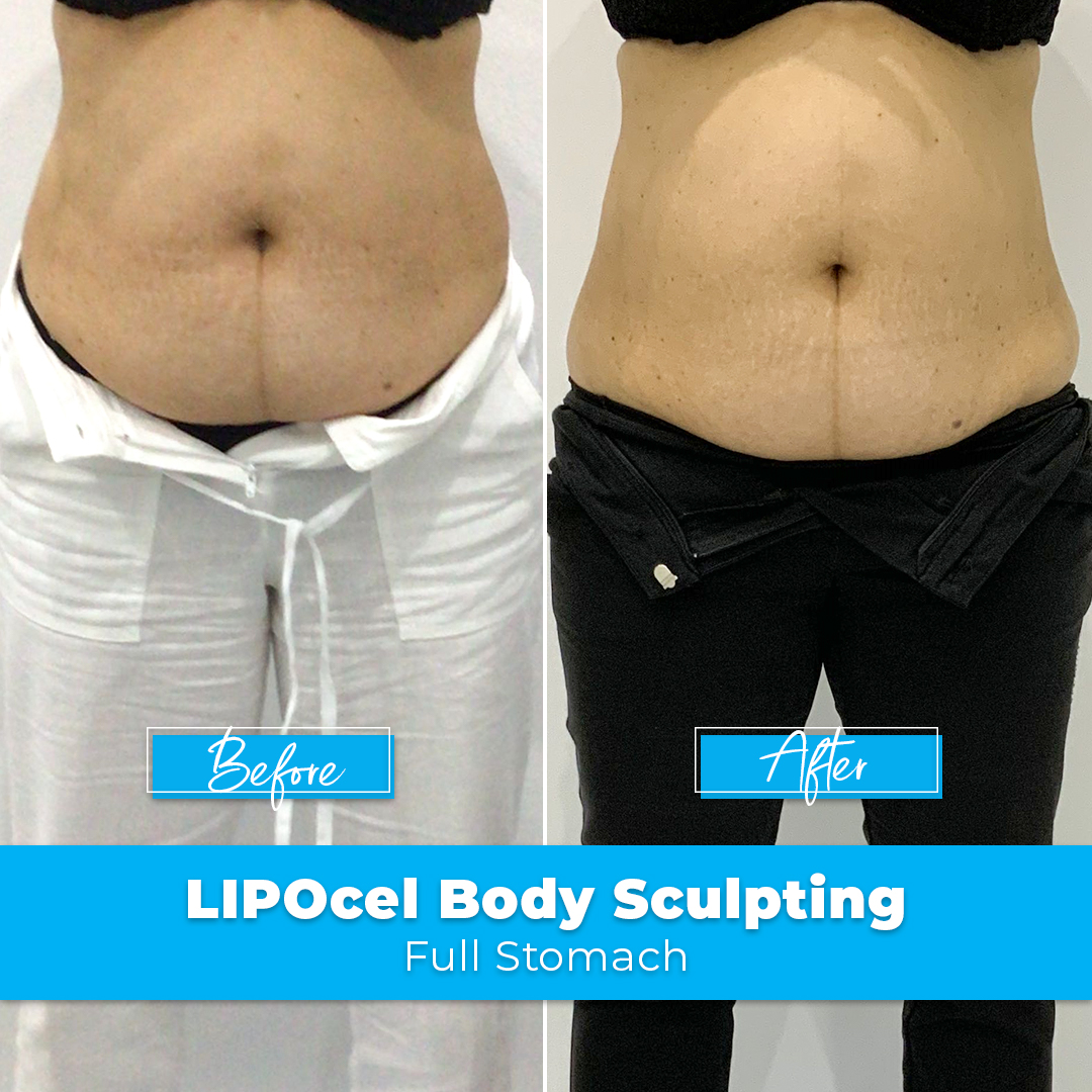 24. LIPOcel Body Sculpting - Stomach
